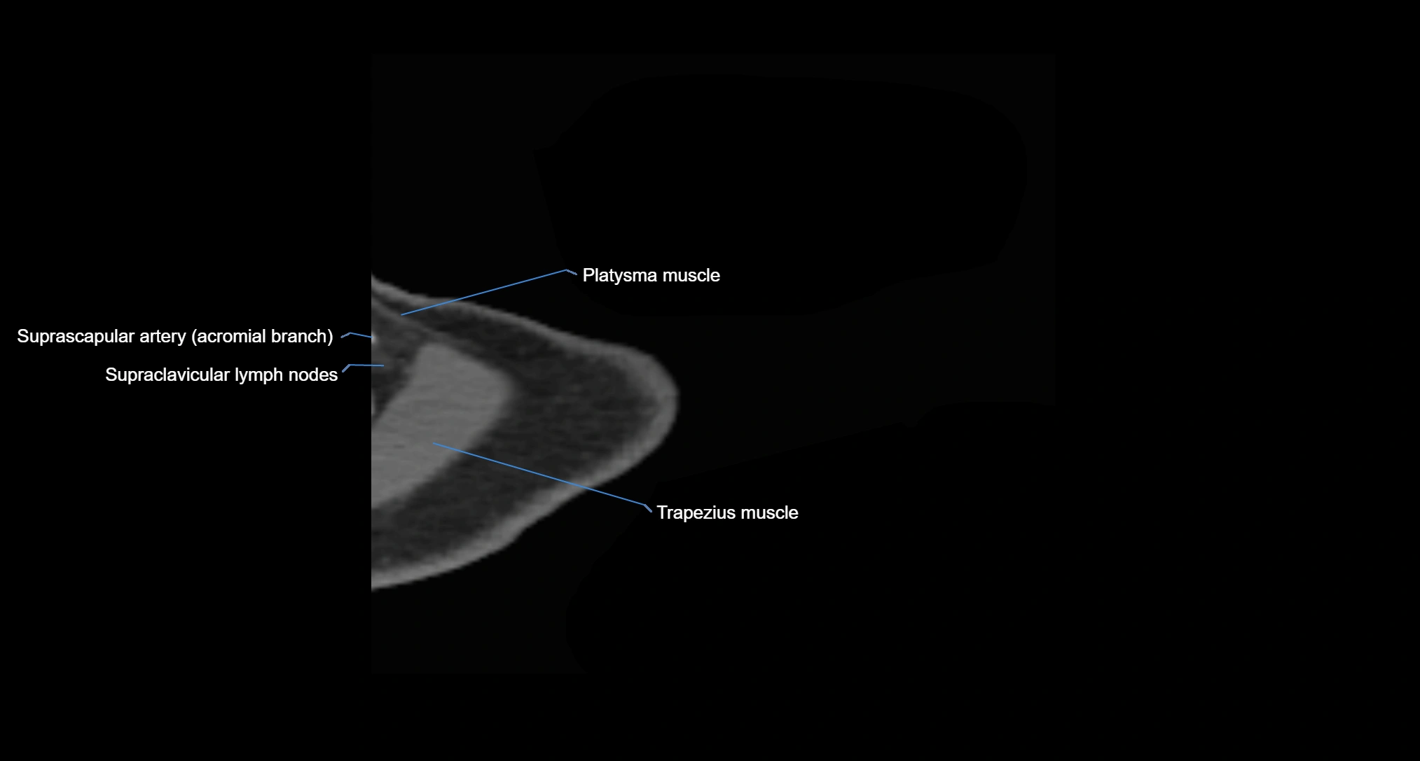 CT Shoulder axial cross sectional anatomy labelled radiology image -00002.webp